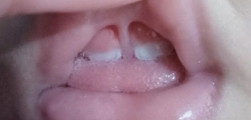 Liptie pada bayi 11 bulan yg sudah tumbuh gigi