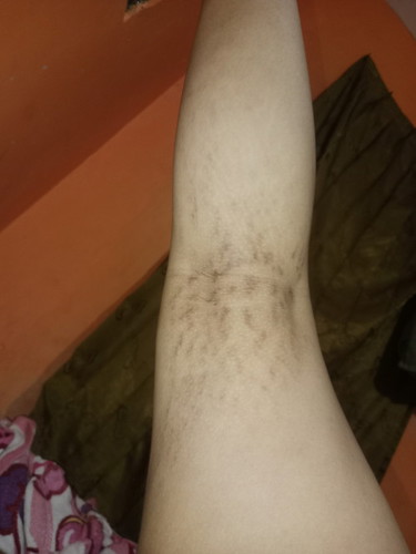 kaya gni wajar gak si ibu ibu?, d perut ga ada streatmach tp d kaki bnyk