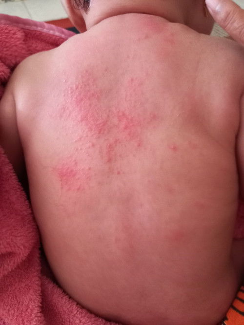 Ruam Merah di Punggung