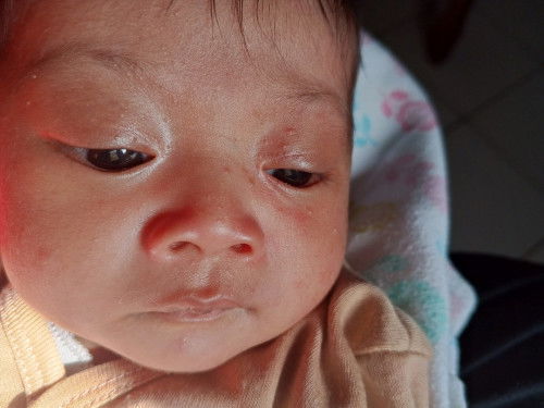 Bruntusan pada wajah bayi