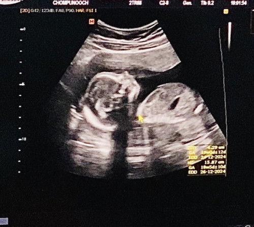 เริ่มตรวจคัดกรองเบาหวานกี่สัปดาห์