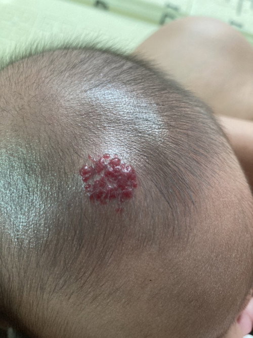 ปรึกษาปานแดงของลูก