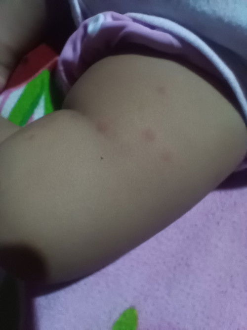 Mga mommies ano po kaya to parang pantal na tumutubo sa baby ko, first time mom kaya di ko po alam g