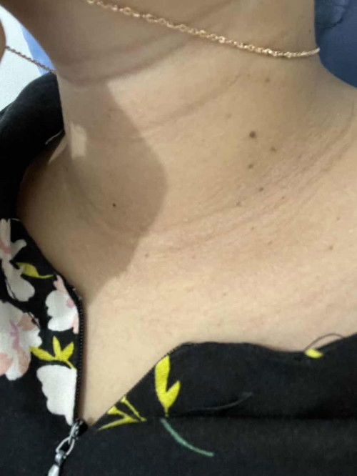 Daging tumbuh bintil2 di leher saat hamil