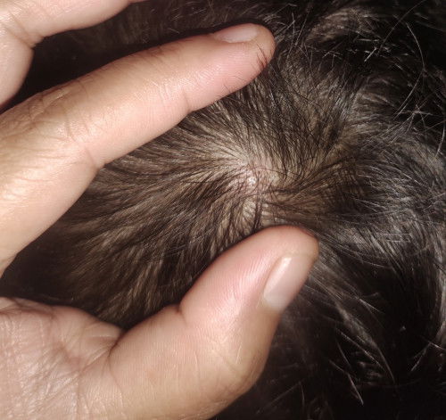 Hi baka my same case dito yung baby ko kasi 2yr old. my tumubo sa knya gnyan bukol. although di nam