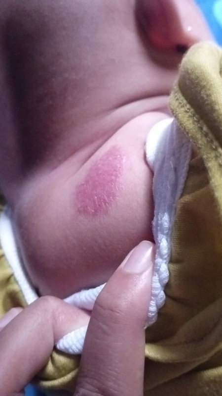 Lecet pada pundak bayi 4 bulan