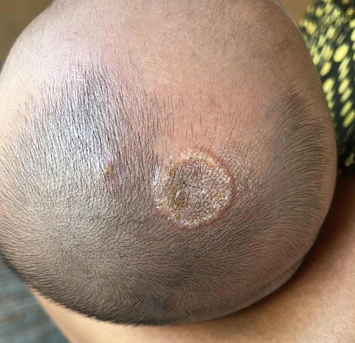 Iritasi kepala bayi newborn