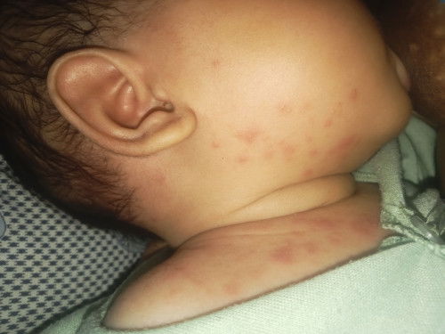 Ruam pada leher dan kepala