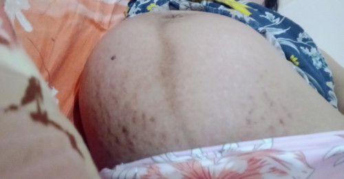 Hello po. Ano po ang recommended nyo na murang moisturizing lotion sa tiyan para iwas stretchmarks?