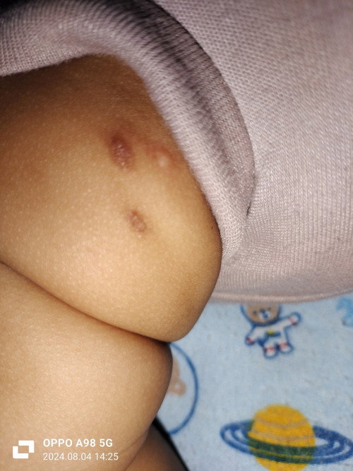 Bekas hitam pada paha bayi