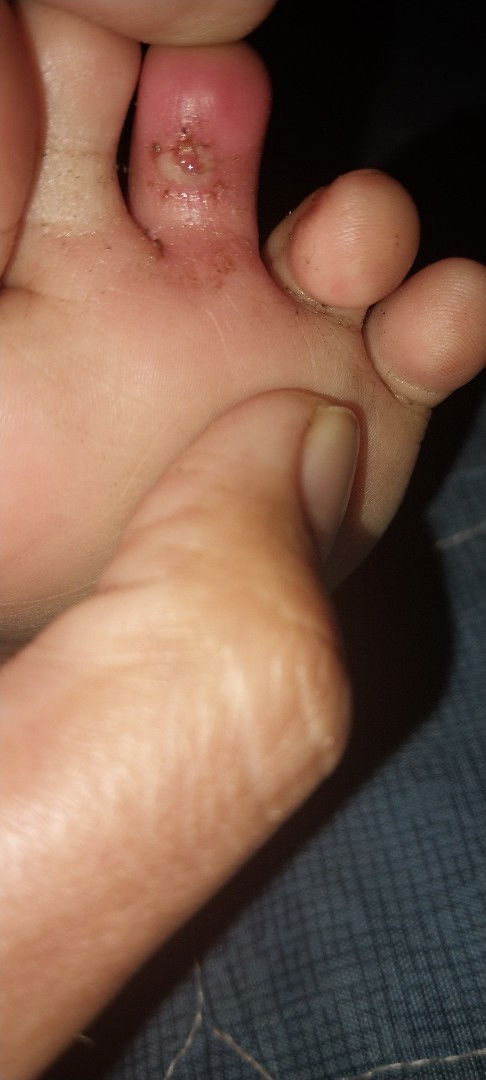 Jari Kaki bernanah