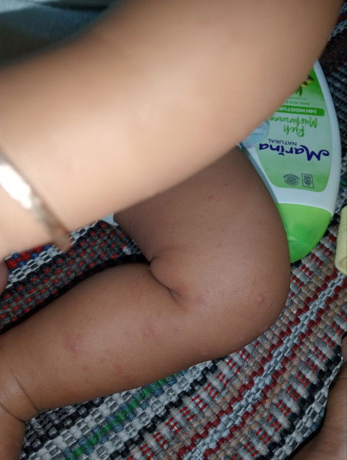 Apakah ini cacar air???