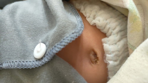 Mau tanya nih Bun obat buat udel si dede biar kering pas udah Puput pusernya apa bun ,