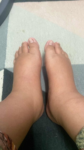 Kaki bengkak 31w