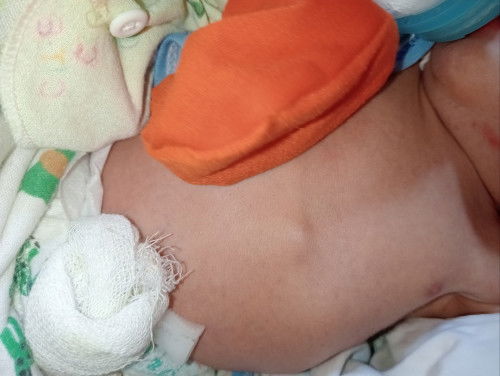 Benjolan di dada bayi