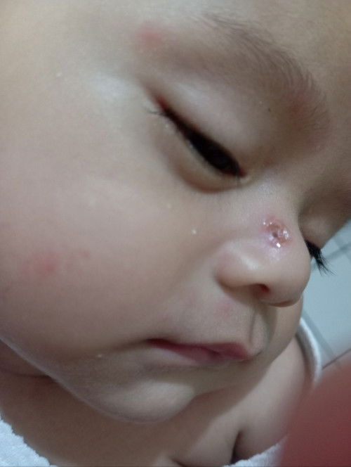 Luka cakaran kuku bayi😭