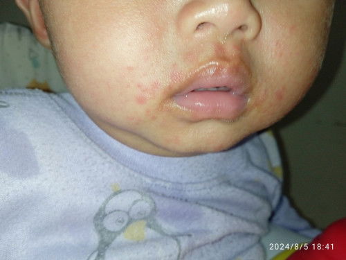 Ruam/bintik merah di wajah