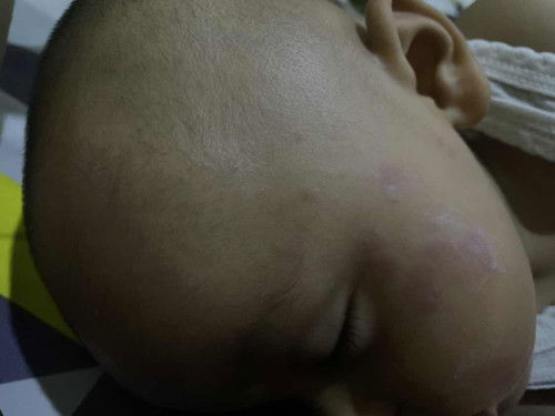 Kemerahan setelah 7harian di imunisasi campak