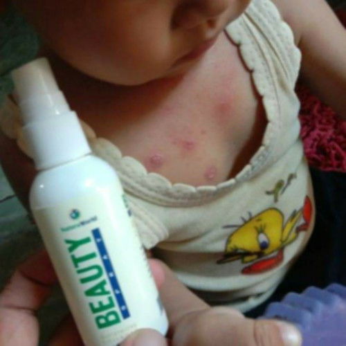 Reaksi alergi tidak boleh disepelekan. Pasalnya, alergi bisa berujung pada reaksi alergi parah