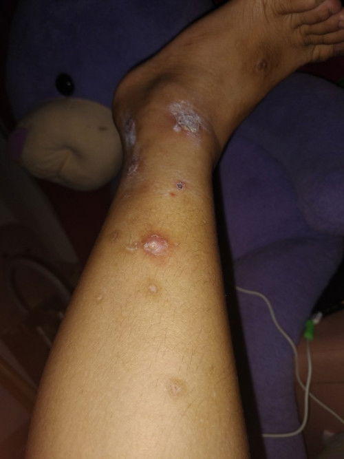 Tanong kulang po normal lang ba sa buntis ang may kati-kati sa balat, yung sa may paa po?