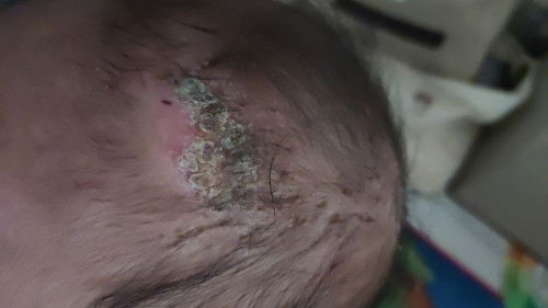 Luka tak kunjung kering