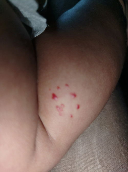 Tanda lahir bintik2 merah