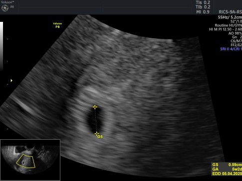 USG Transvaginal 5week