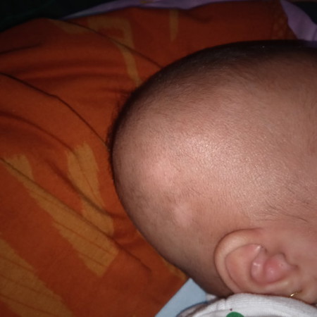 Flek putih di kepala bayi