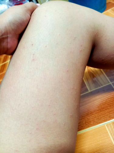 แม่ๆบ้านไหนเป็นแบบหนูบ้างพอเข้าไตร์มาส3เป็นผื่นตุ่มคันตามตนตัวยี่งเกายี่งขื้นแบบนี้จะเป็นอตรายต่อลูก
