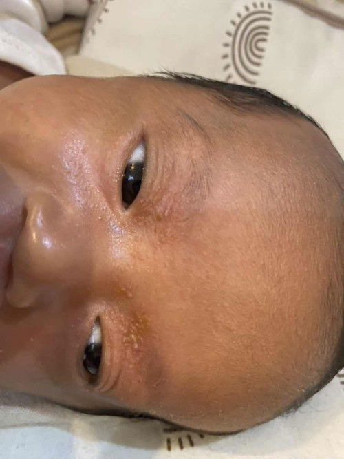 Bruntus di atas mata