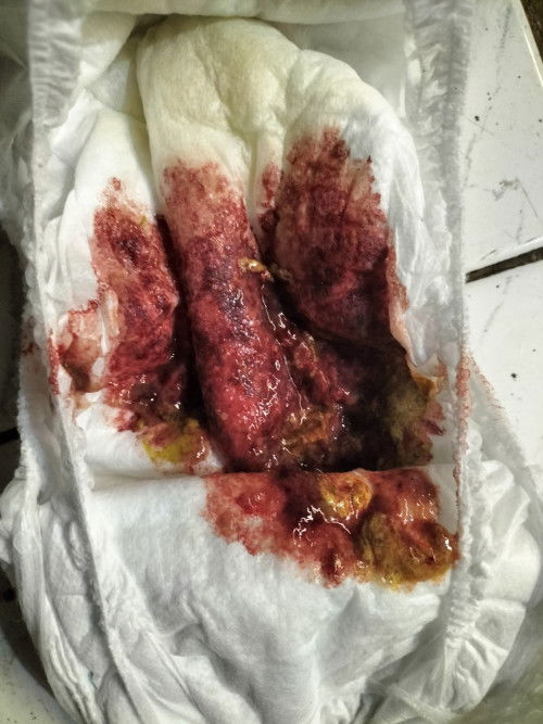 Bayi 17 bulan pup berdarah