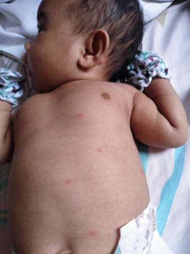 1 month old may bulutong