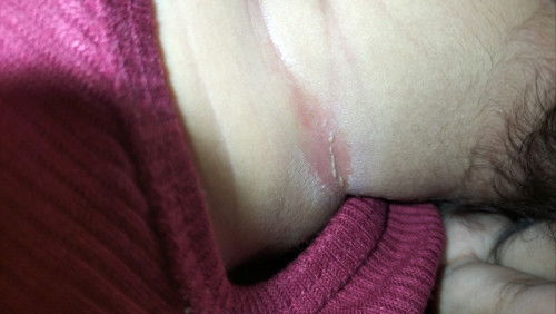 Kalo ruam apa obatnya ya bun? Masak mertua suruh pake minyak bawang