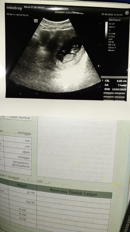 Usia kehamilan 11w4d hasil usg
