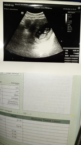 Usia kehamilan 11w4d hasil usg