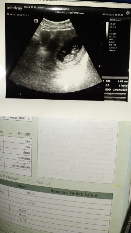 Usia kehamilan 11w4d