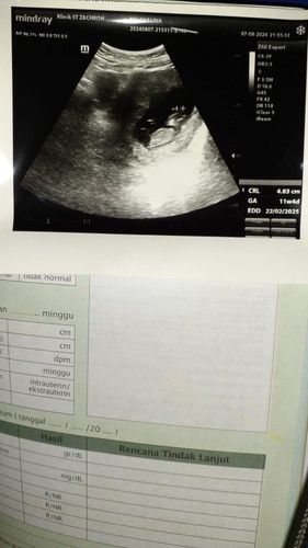 Usia kehamilan 11w4d