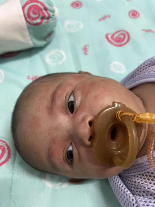 hi mommies betulke ruam merah mcmni normal baby 2bulan?