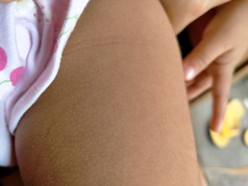 White dots sa skin ni Baby