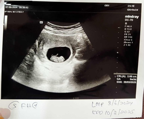 Scan pregnancy 9w2d
