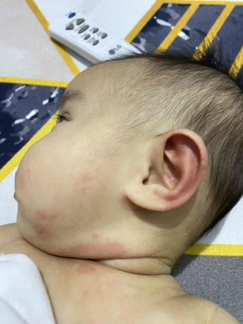 Allergy po ba ito sa formula?