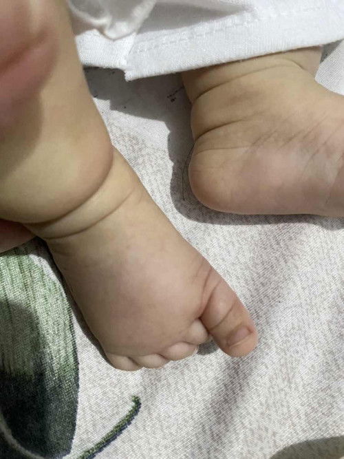 Allergy or insect bite?