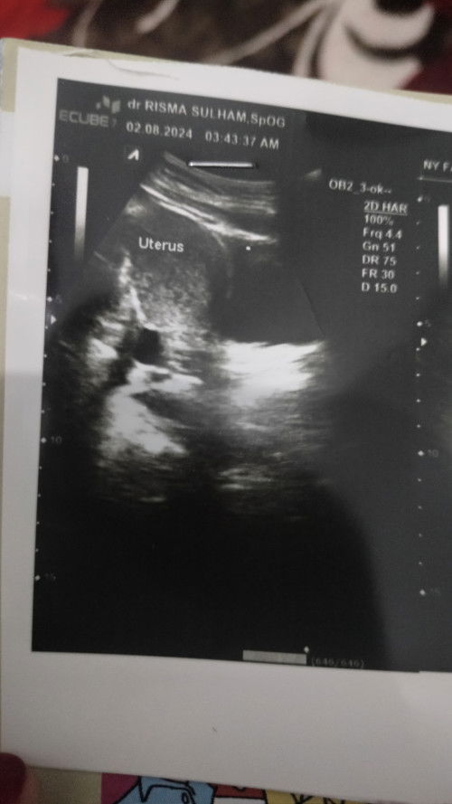 Rahim membesar dan janin belum jelas