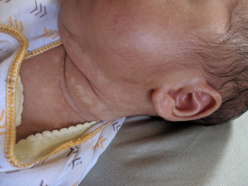 BERCAK PUTIH, AWALNYA MERAH