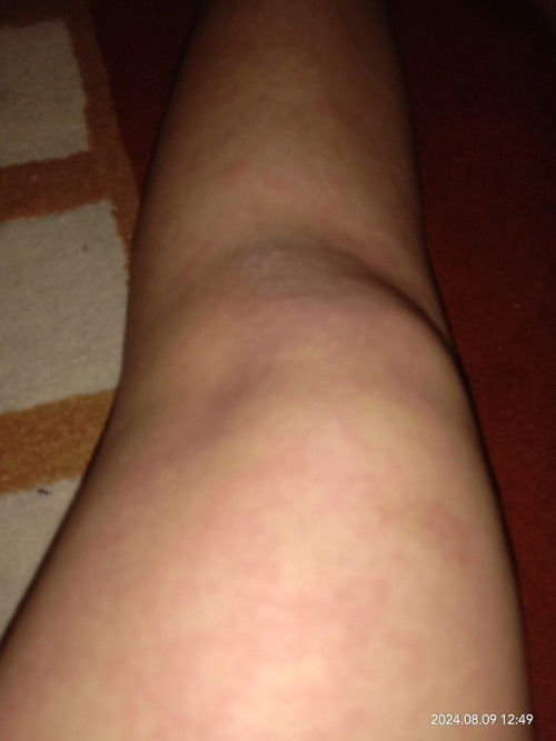 Hamil 30w kayak campak