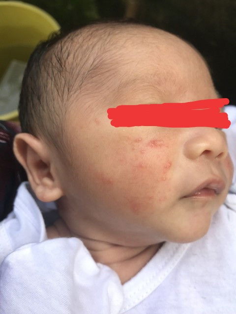 Normal lang ba ang pimples sa newborn?
