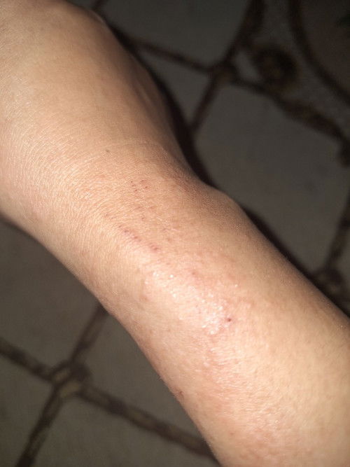 Hamil masuk 32w tm 3 tanganku tiba2 gatel gatel apa ya mam obatnya