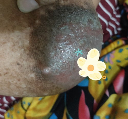 Puting area payudara kering bersisik dan mengelupas