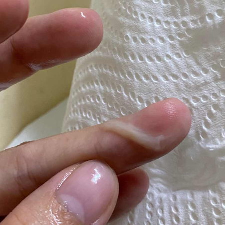 ครั้งแรกเมื่อปลายเดือน กรกฎาคม เป็นแบบนี้ใสกว่า นี้แต่เยอะกว่านี้ค่ะ เมื่อ2วันที่แล้วก็มีแบบนี้ไหลออกมาอีก ล่ะวันนี้กะมีแบบนี้