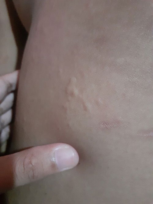 Gatal setelah melahirkan